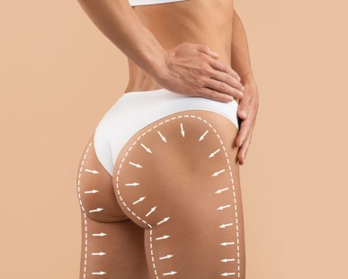 Brazilian Butt Lift: When Will You See Curves?