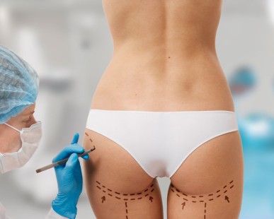 Brazilian Butt Lift in Istanbul: What to Expect