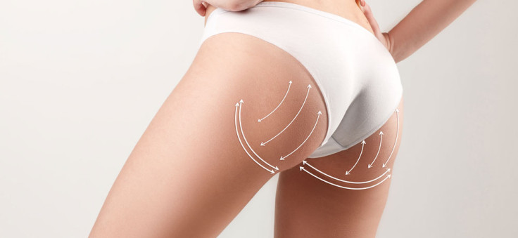 10 Dinge, die Sie über das Brazilian Butt Lift (BBL) wissen müssen