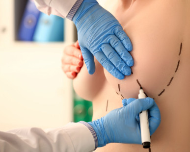 Breast Implant: When Will You See Final Shape?