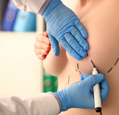 ¿Cuánto tardan los implantes mamarios en asentarse en su lugar?