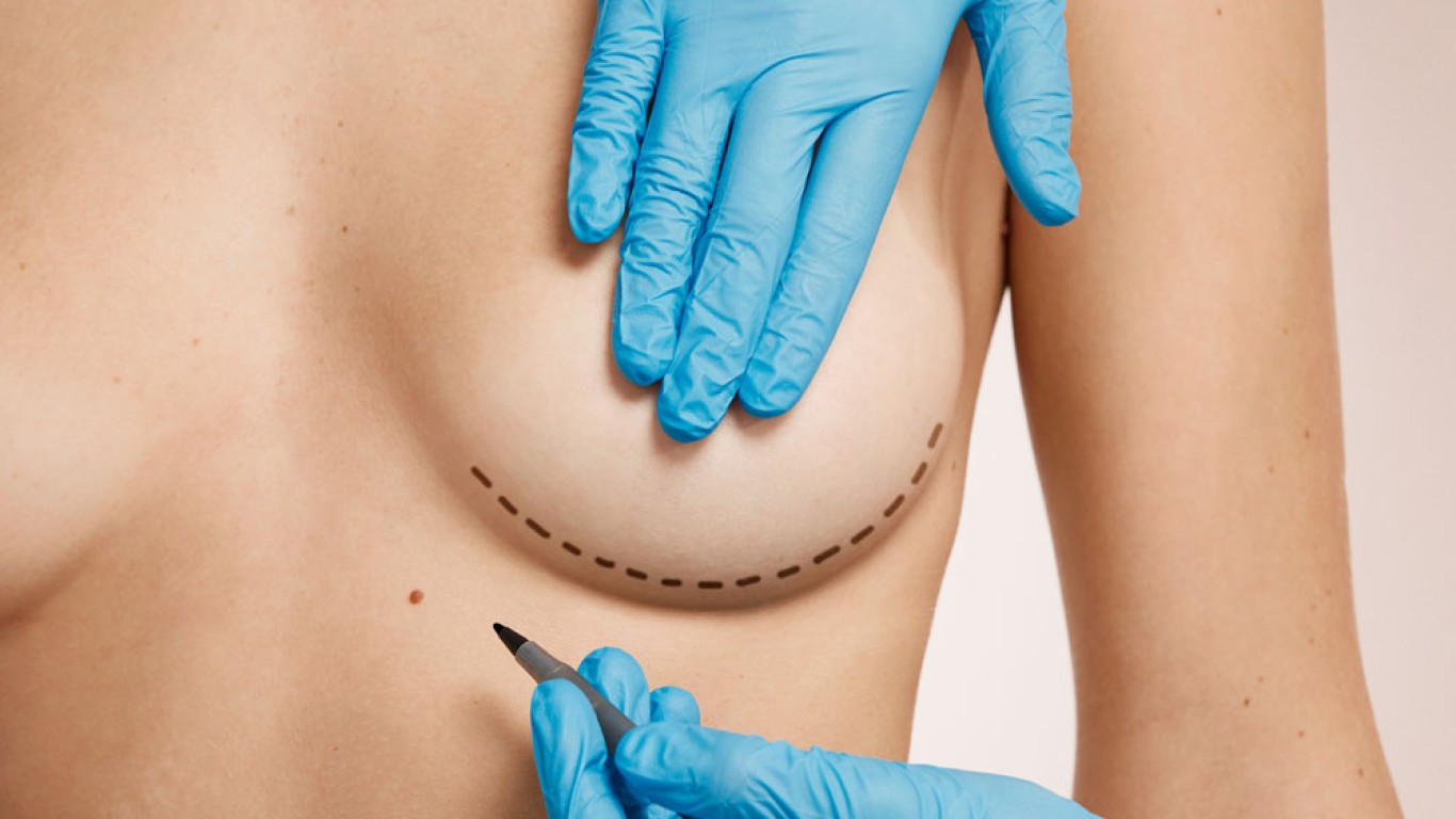 ¿Qué puedo esperar de la cirugía de sustitución de implantes mamarios?