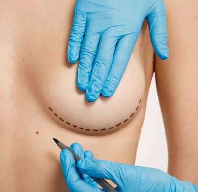 Chirurgie de remplacement des implants mammaires : à quoi s'attendre