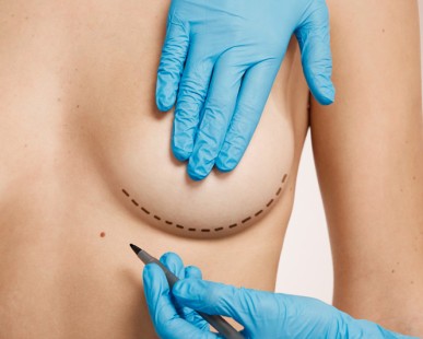 5 Reasons Mastopexy in Turkey Is Gaining Global Attention