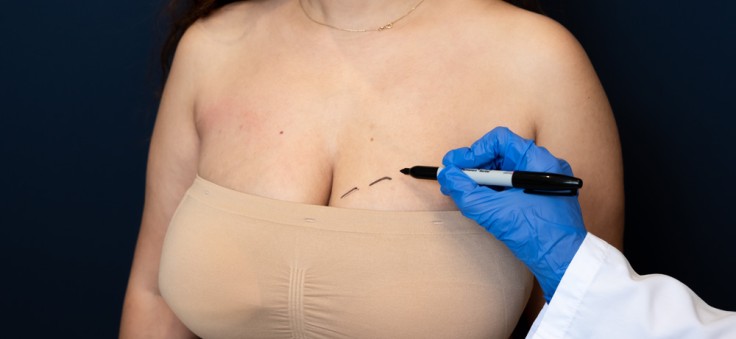 Breast Reduction Cost: Why Is Turkey Popular? 