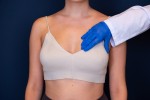 Breast Reduction Scar Care That Really Works