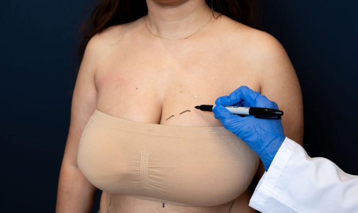 Everything You Need to Know About Breast Surgery