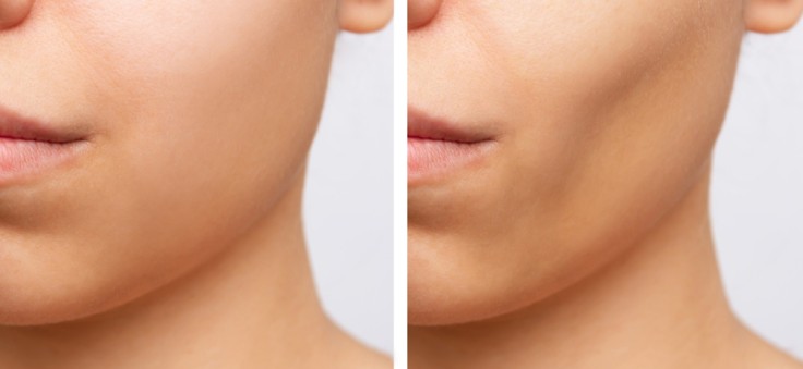 Alles, was Sie über Buccal Fat Removal (Wangenfettentfernung) wissen müssen