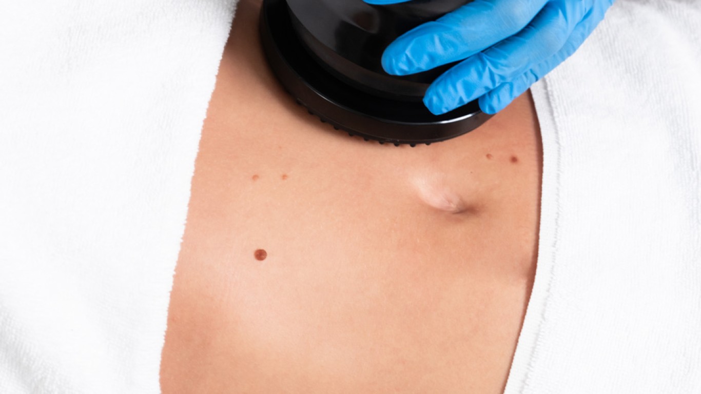 Kryolipolyse gegen Cellulite: Funktioniert sie wirklich?