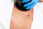 Everything You Should Know About Cellulite Treatment