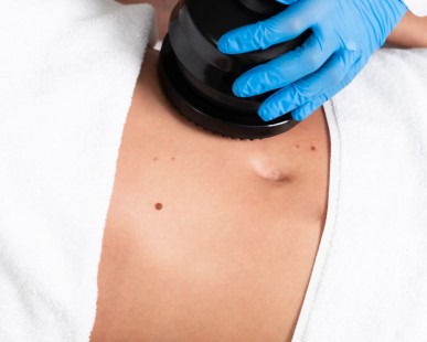 Alles, was Sie über Cellulite-Behandlungen wissen sollten