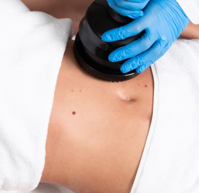 Criolipólisis para la celulitis: ¿realmente funciona?