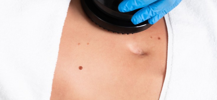Cryolipolysis for Cellulite: Does It Really Work?