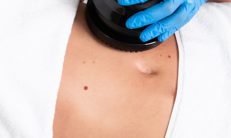 Everything You Should Know About Cellulite Treatment