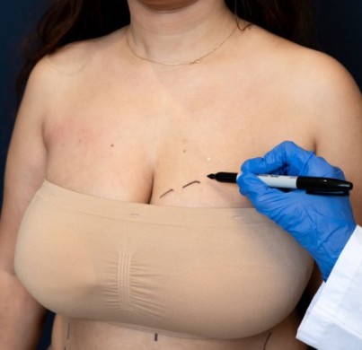 ¿Hay límite de edad para someterse a una cirugía de pecho?