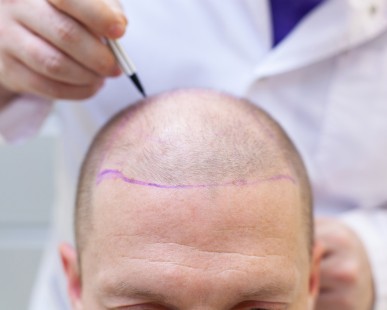 FUE vs DHI: Which is Better in Hair Transplant for Women?