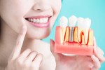 Dental implants vs bridges: Which Option Offers Better Longevity?