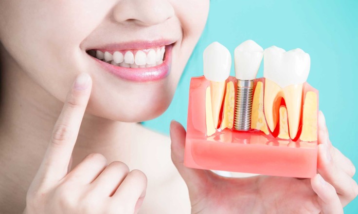 Dental implants vs bridges: Which Option Offers Better Longevity?