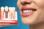 7 Things to Know Before Getting Dental Implants Abroad