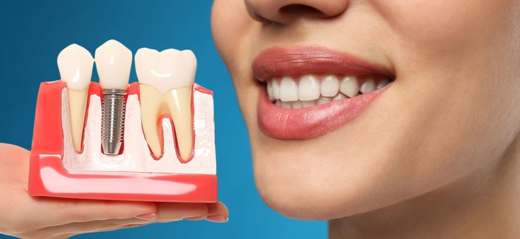 7 Things to Know Before Getting Dental Implants Abroad