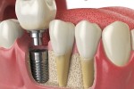 Dental Implants Cost 2025