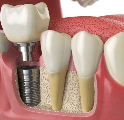 Precio de los implantes dentales en 2025