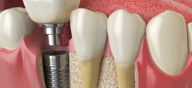Dental Implants Cost 2025