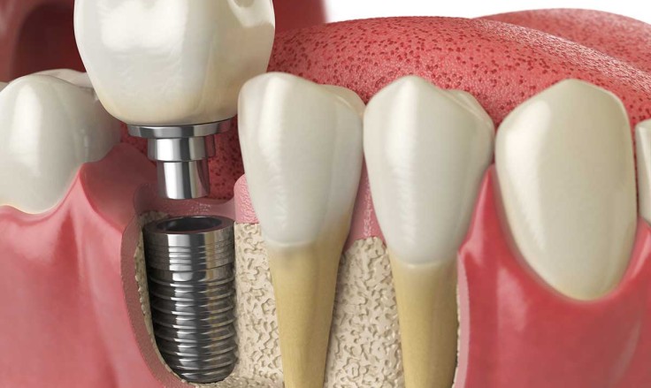 Dental Implants Cost 2025