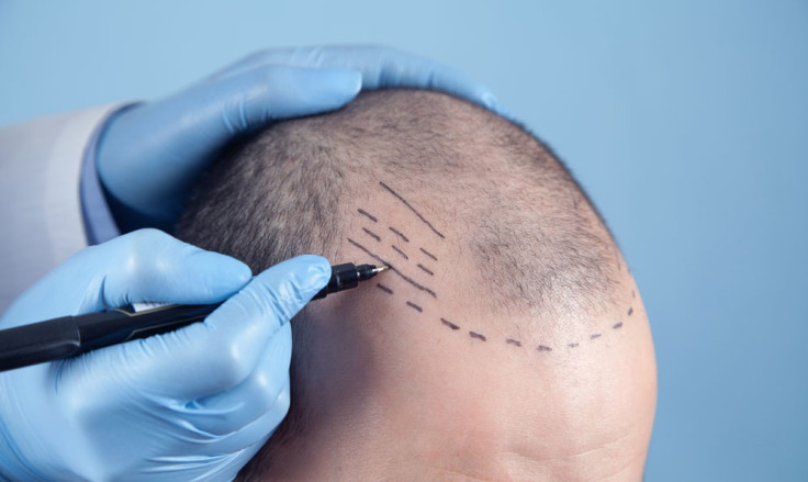 Ce que vous devez savoir sur l’implantation directe de cheveux (DHI)