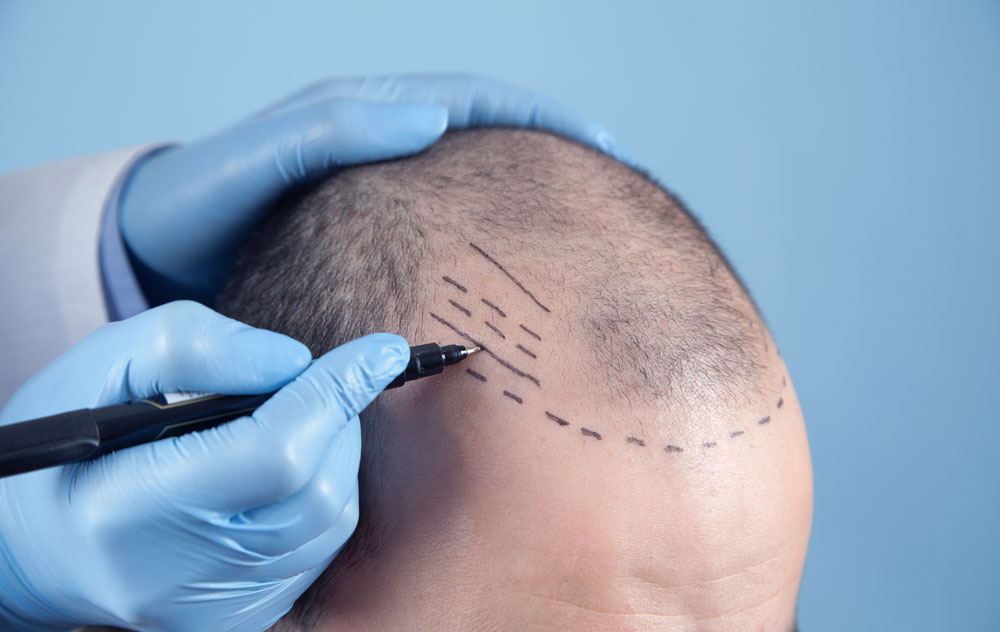 Ce que vous devez savoir sur l’implantation directe de cheveux (DHI)