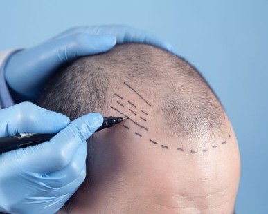 DHI en Turquie : le moment idéal pour faire sa greffe de cheveux