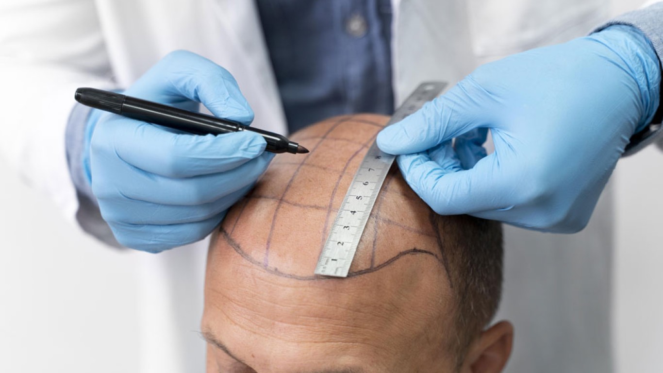 5 Tips for DHI Hair Transplant Success