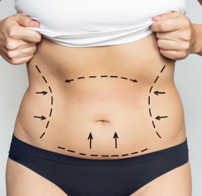 Everything You Need to Know About Fat Reduction