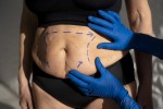 Fat Reduction Treatments That Improve Body Contours