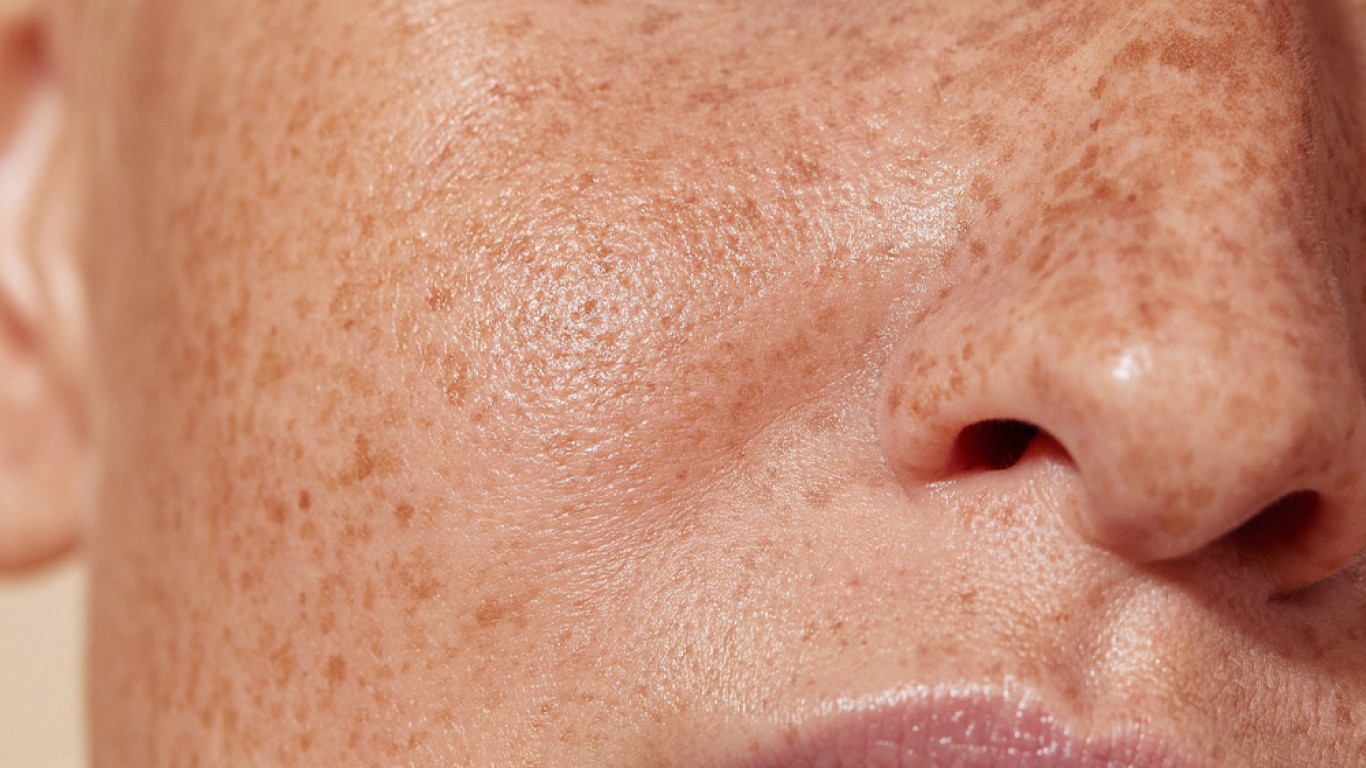How Long Do Freckle Removal Results Typically Last?