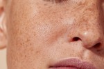 How Long Do Freckle Removal Results Typically Last?
