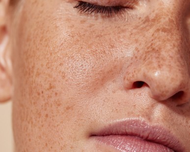 How Long Do Freckle Removal Results Typically Last?