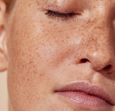 How Long Do Freckle Removal Results Typically Last?