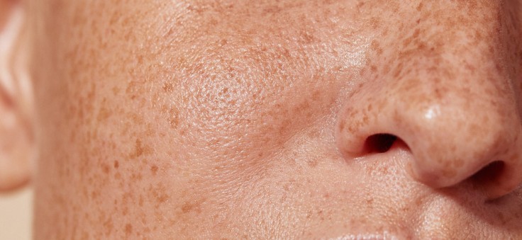 How Long Do Freckle Removal Results Typically Last?