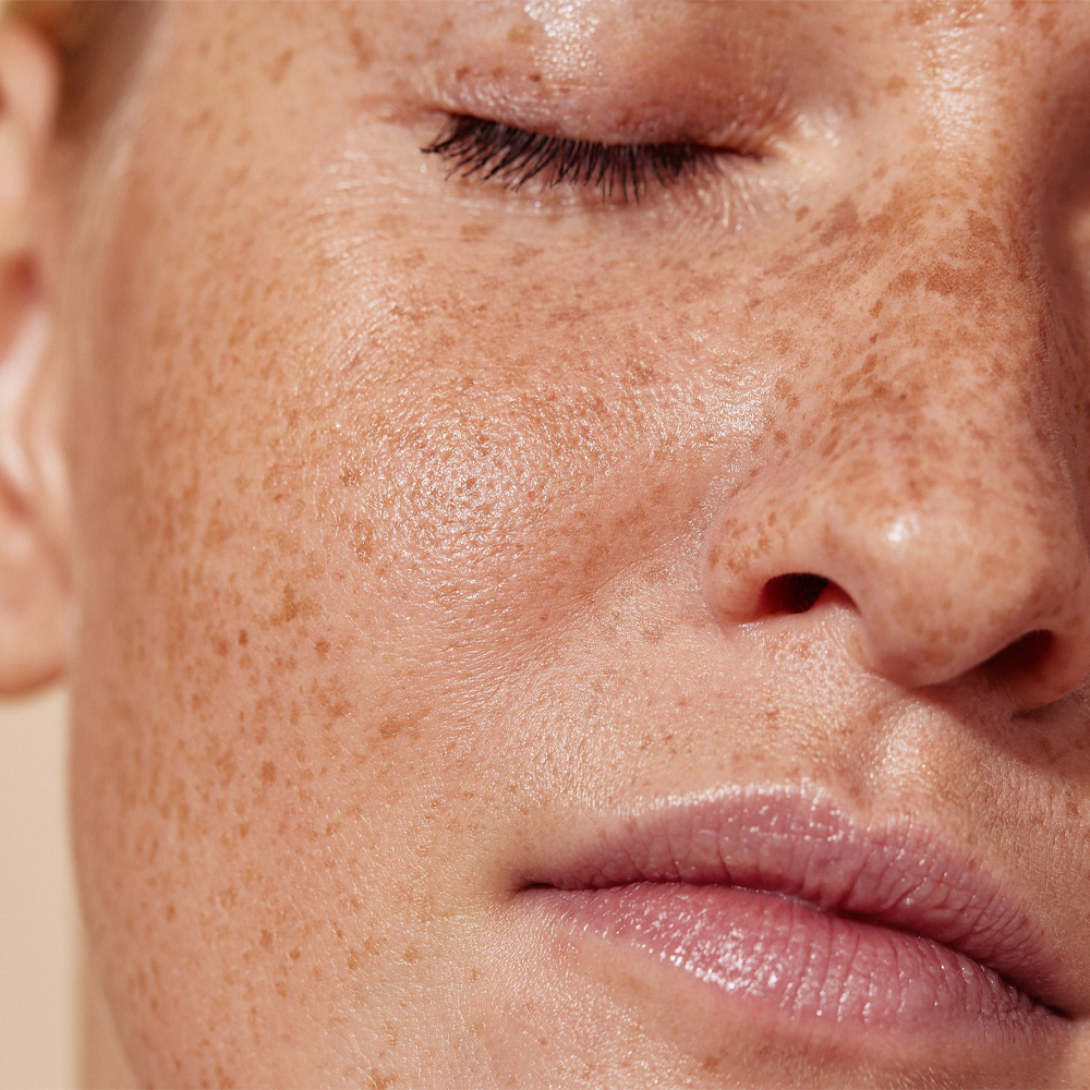 Freckle Removal Treatments