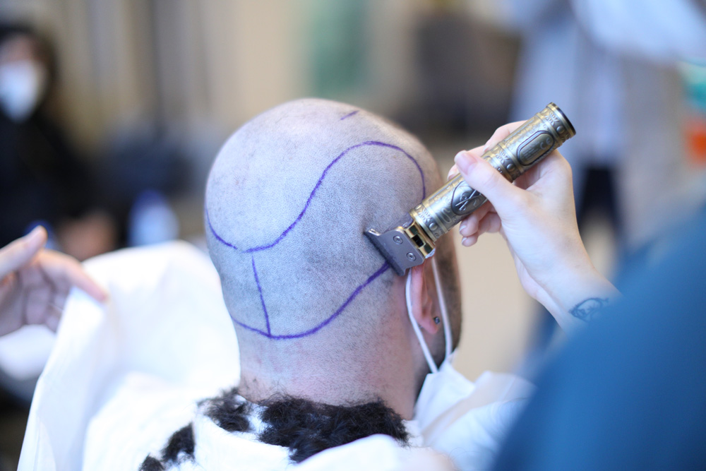 FUE-Haartransplantation in der Türkei