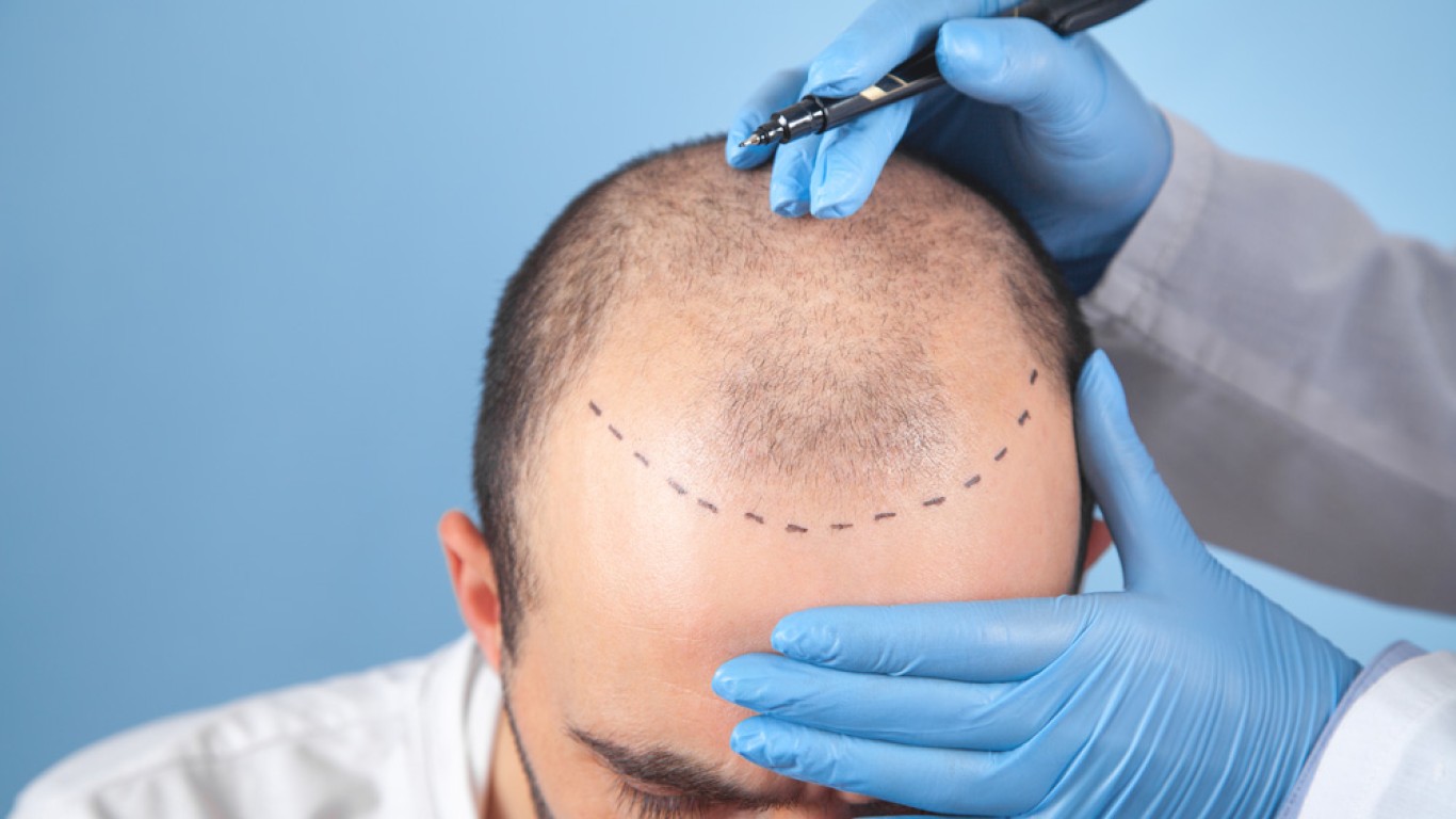 How FUE Hair Transplants in Istanbul Compare to Global Alternatives