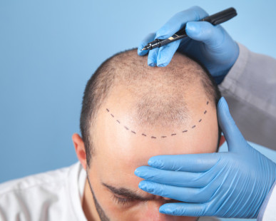 FUE Recovery Timeline: What to Expect After Surgery