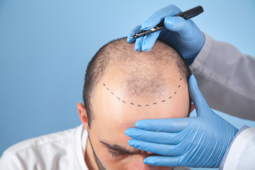 Wie lange dauert es, bis das Haar nach einer Haartransplantation wächst?