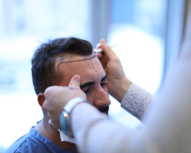 Greffe de cheveux par extraction d'unités folliculaires (FUE) en Turquie : à quoi s'attendre, procédure et coût 