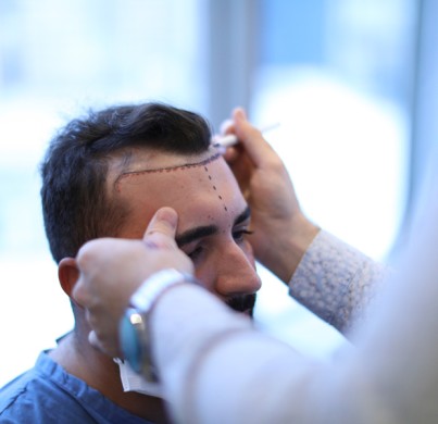 La repousse des cheveux après une greffe FUE: la chronologie