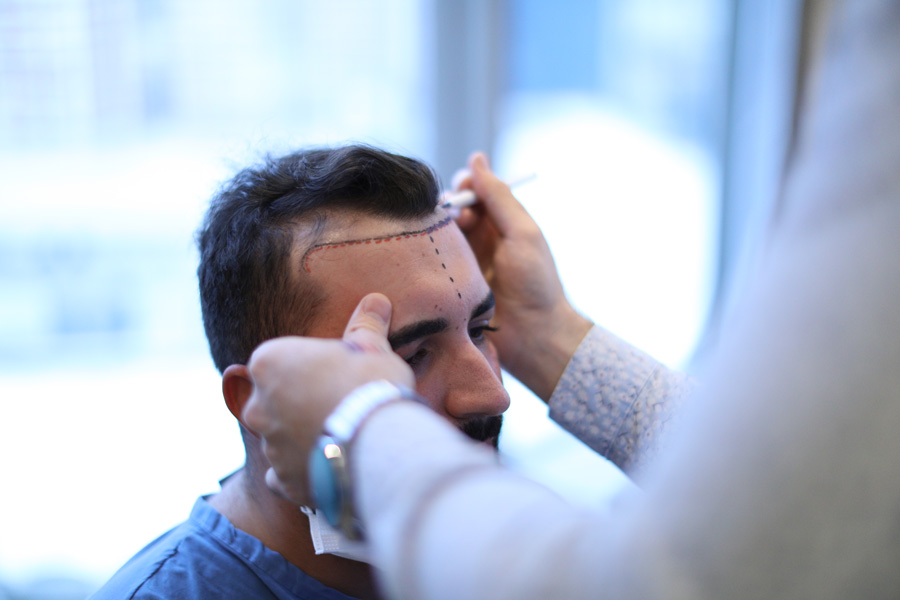 Greffe de cheveux par extraction d'unités folliculaires (FUE) en Turquie : à quoi s'attendre, procédure et coût 