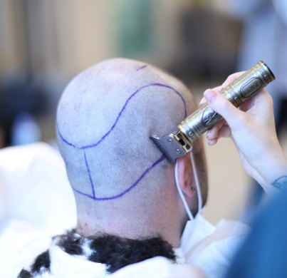 Cirugía Capilar: ¿Cuál es la diferencia entre la extracción de Unidades Foliculares (FUE) vs. Implante Directo de Cabello (DHI)?