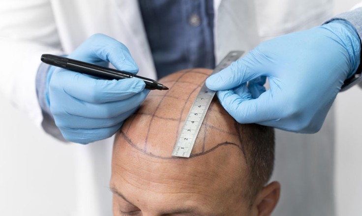 FUE vs DHI: Which Hair Transplant Method Is Right for You?