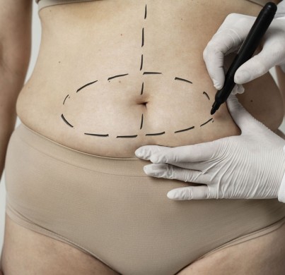 ¿Es suficiente una mini abdominoplastia o necesitarás algo más?